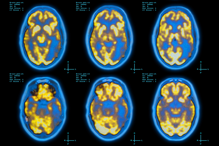 A positron emission tomography scan of the brain